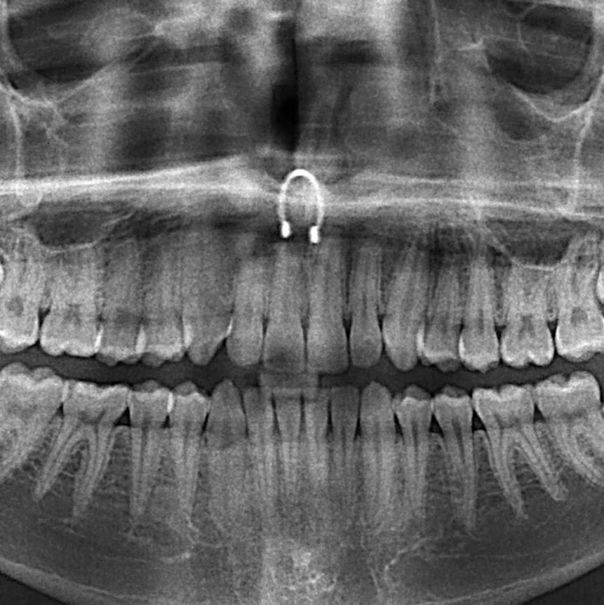My real teeth and septum piercing